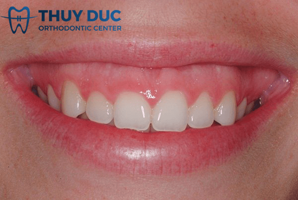 Nguyên nhân gây cười hở lợi 1 Cắt lợi sau niềng răng