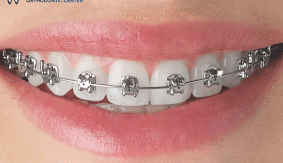 Dây cung niềng răng bị dài ra – nguyên nhân và cách xử lý