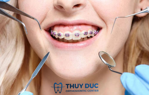 Có nên cắt lợi sau niềng răng không?