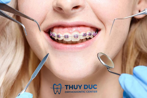 Có nên cắt lợi ngay sau khi niềng răng không? 1 Cắt lợi sau niềng răng