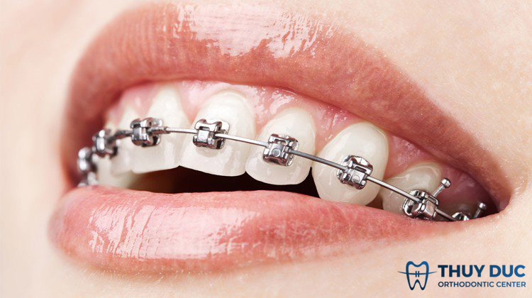 Niềng răng vẫn phun môi thì làm sao? 1