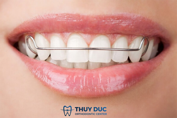 Vì sao bạn cần đeo hàm duy trì sau niềng răng? 1 Vì sao bạn cần đeo hàm duy trì sau niềng răng? 1