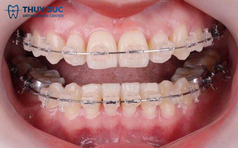 Người bị tụt lợi có niềng răng được không? 1