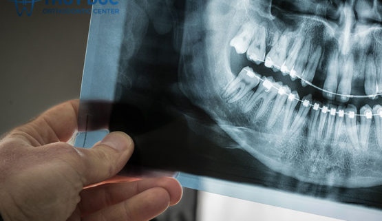 Niềng răng có chụp X-quang được không?