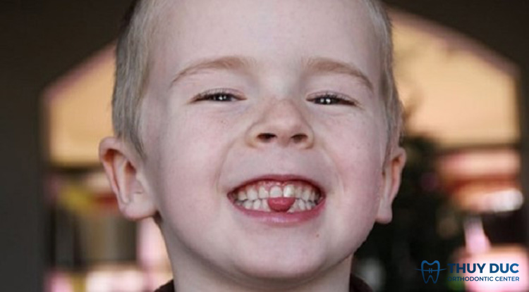 Giải đáp cụ thể tật đẩy lưỡi là gì? 1 Giải đáp cụ thể tật đẩy lưỡi là gì? 1