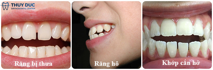 Hậu quả của tật đẩy lưỡi bạn cần biết 1 Hậu quả của tật đẩy lưỡi bạn cần biết 1