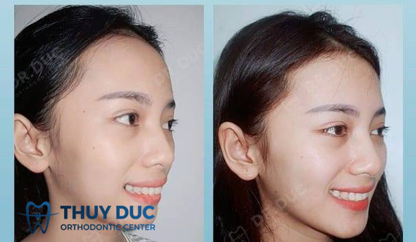 Mặt lệch có nên niềng răng không? 3 Mặt lệch có nên niềng răng không? 3