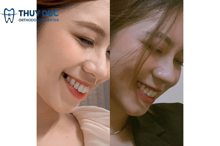 Niềng răng giúp thay đổi góc nghiêng như thế nào? 3