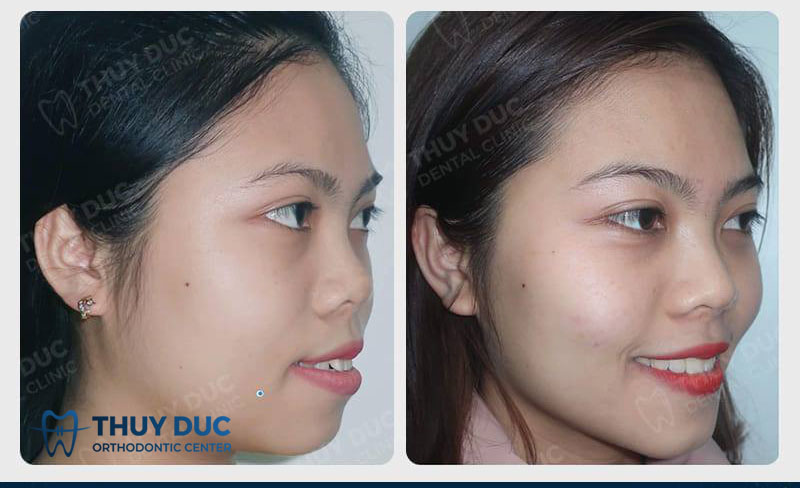 Mặt lệch có nên niềng răng không? 2 Mặt lệch có nên niềng răng không? 2