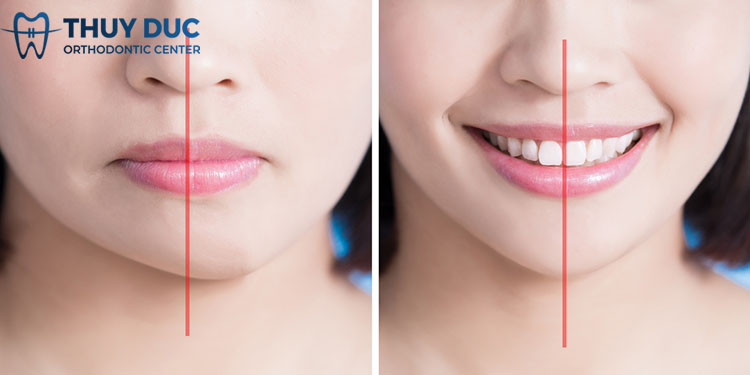 Mặt lệch có nên niềng răng không? 1 Mặt lệch có nên niềng răng không? 1