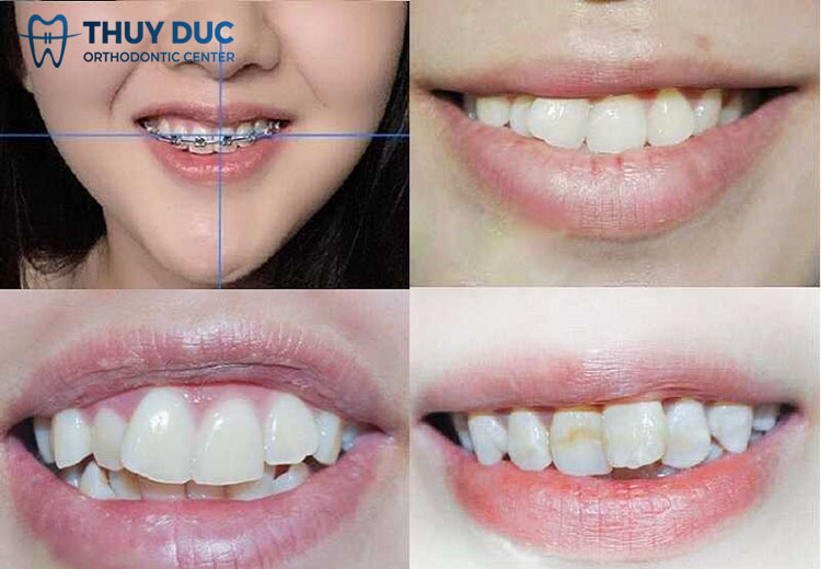 Mặt lệch có nên niềng răng không? 1 Mặt lệch có nên niềng răng không? 1