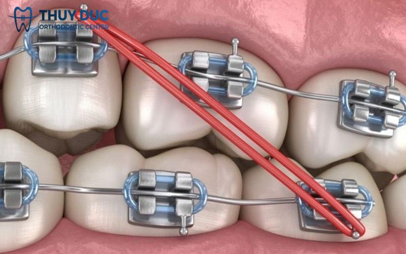 Thun liên hàm có tác dụng gì? 1 Thun liên hàm có tác dụng gì? 1
