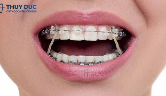 Thun liên hàm – những điều bạn cần biết