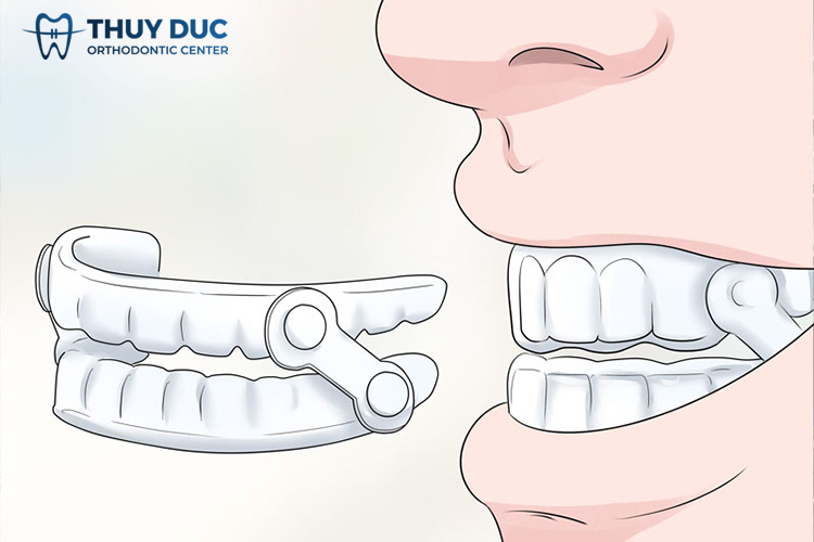 Cách chữa nghiến răng khi ngủ với máng nhựa 1