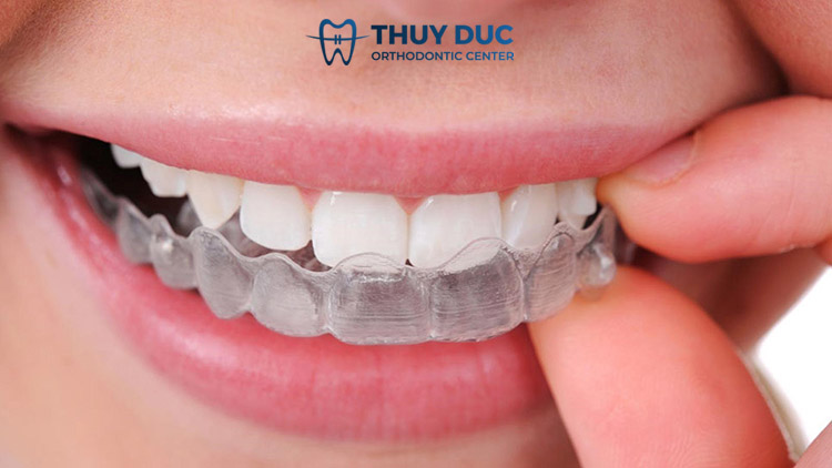 Cách chữa nghiến răng khi ngủ bằng niềng răng 1