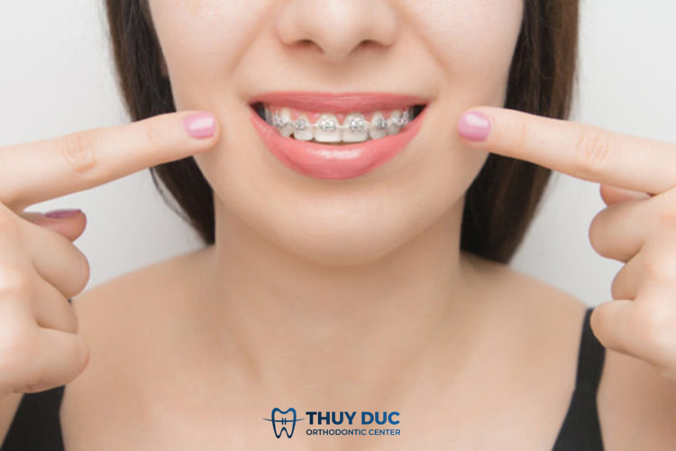 Lợi dễ bị chảy máu có niềng răng được không? 1