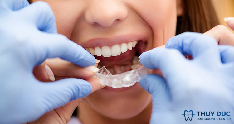 Giải đáp máng chống nghiến răng là gì? 1