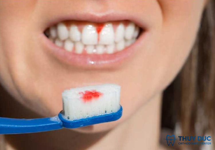 Nguyên nhân khiến lợi dễ bị chảy máu 1