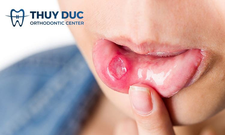 Loét miệng 1 Loét miệng 1