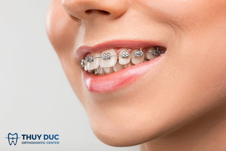 Niềng răng thẩm mỹ 1