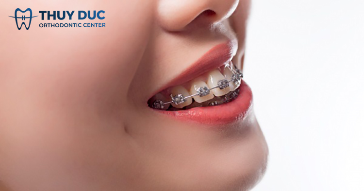 Tại sao niềng răng xong vẫn hô? Cách phòng tránh hiệu quả 1