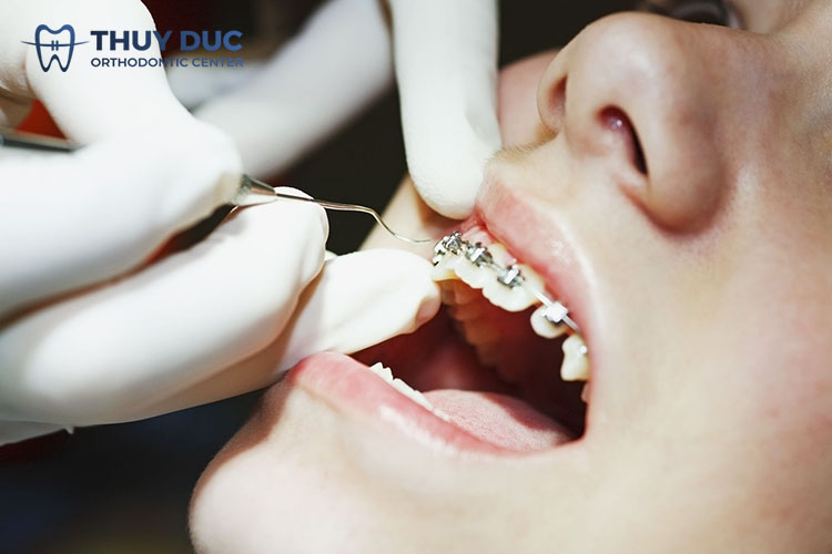 Tháo niềng răng có đau không? Những lưu ý sau tháo niềng 1 Tháo niềng răng có đau không? Những lưu ý sau tháo niềng 1