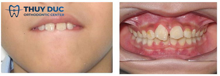 Tại sao niềng răng xong vẫn hô? 1