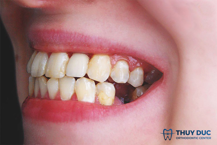 2. Các trường hợp gãy răng phổ biến và khả năng niềng răng đi kèm 1