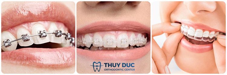 Hiểu nhanh về niềng răng 2