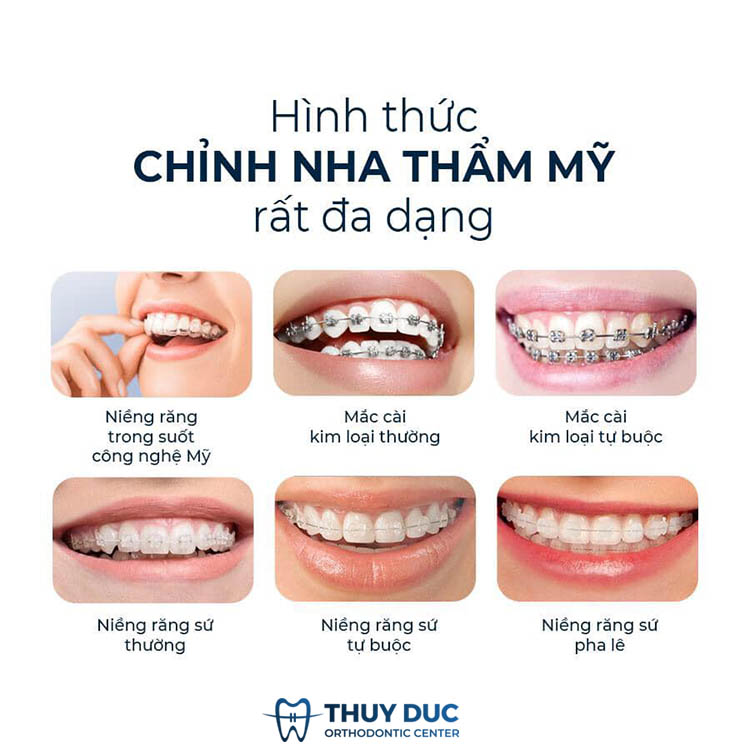 Niềng răng hô hàm trên nên dùng phương pháp nào? 1 Niềng răng hô hàm trên nên dùng phương pháp nào? 1