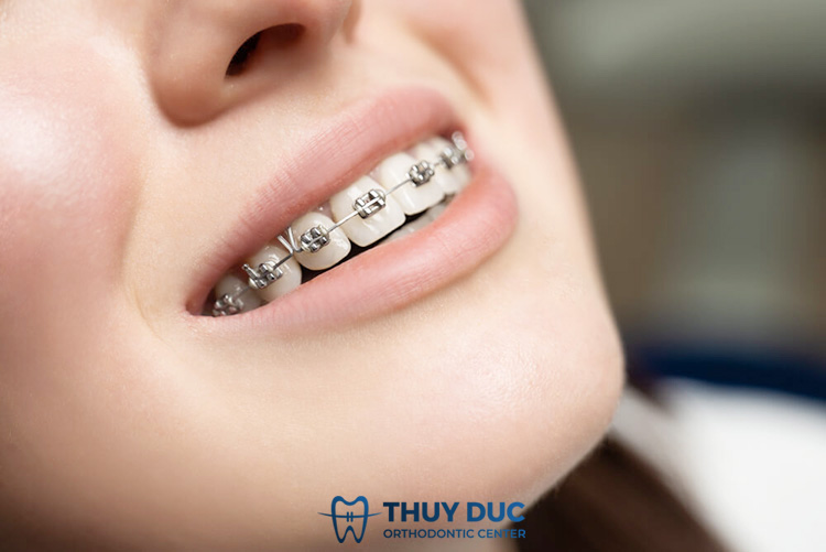 Hô hàm trên có niềng được 1 hàm không? 1 Hô hàm trên có niềng được 1 hàm không? 1