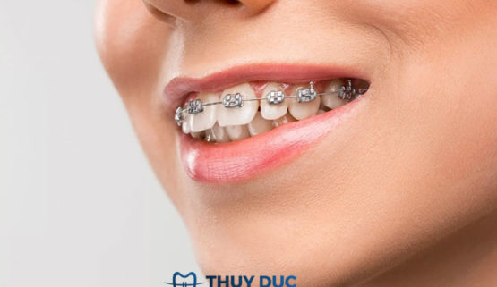 Hô hàm trên có niềng răng được không?