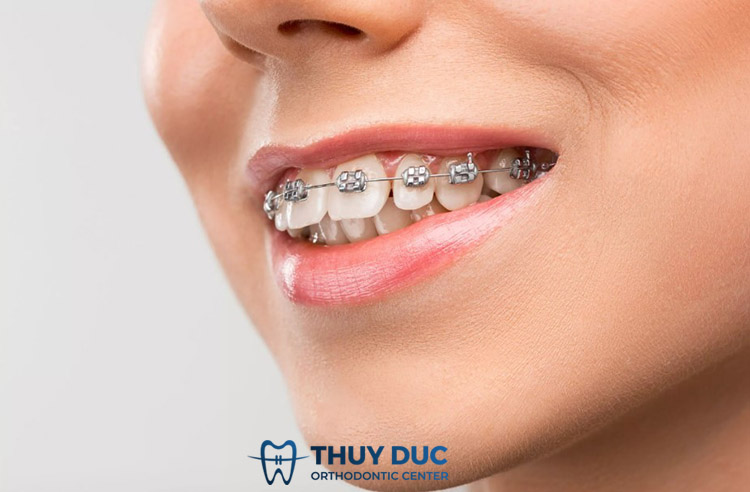 Hô hàm trên có niềng được không? 1 Hô hàm trên có niềng được không? 1