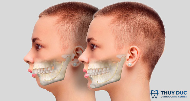 Các loại răng hô hàm trên 1 Các loại răng hô hàm trên 1