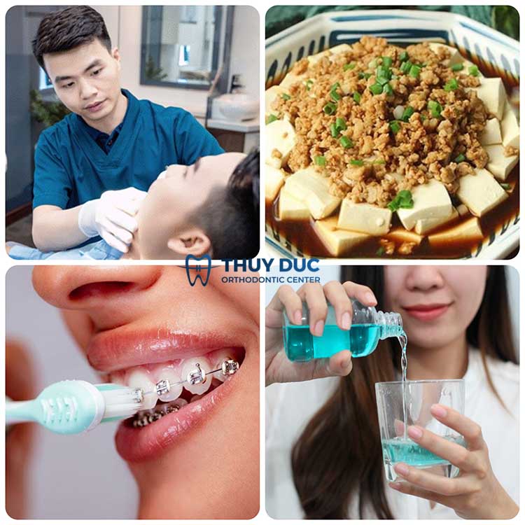 Niềng răng đã lấy tủy cần lưu ý điều gì? 1