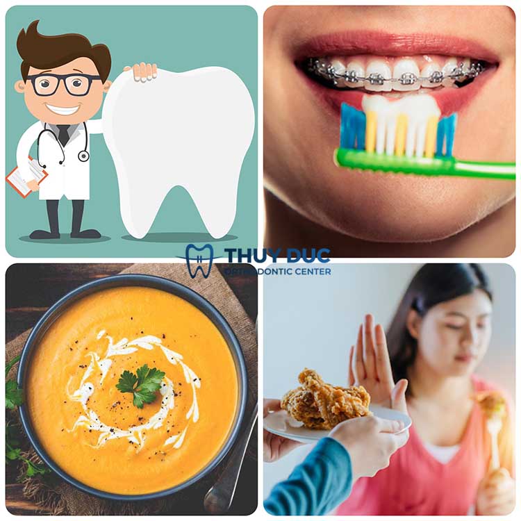 Những lưu ý khi niềng răng đã trám 1 Những lưu ý khi niềng răng đã trám 1