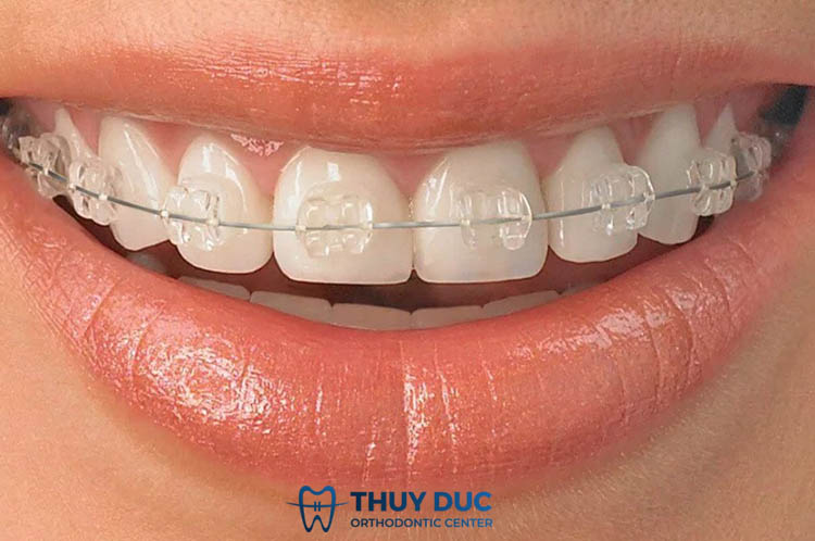 Răng đã trám có niềng được không? 1 Răng đã trám có niềng được không? 1