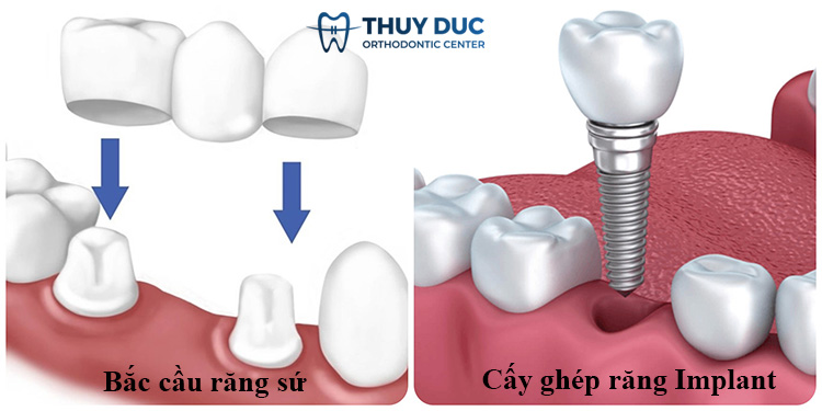 3. Các phương pháp trồng răng sau khi niềng 1