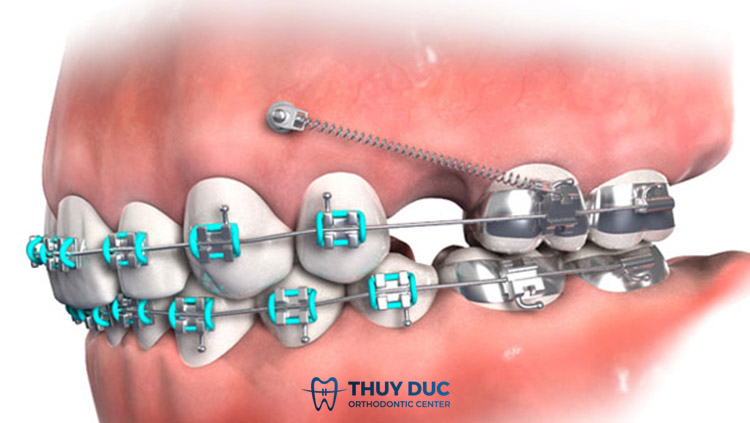 Bắt minivis ở vị trí nào, có trong gần răng nhai không? 1