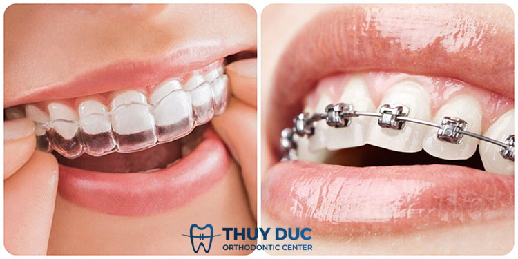 Bị viêm nướu mãn tính nên niềng Invisalign hay mắc cài? 1