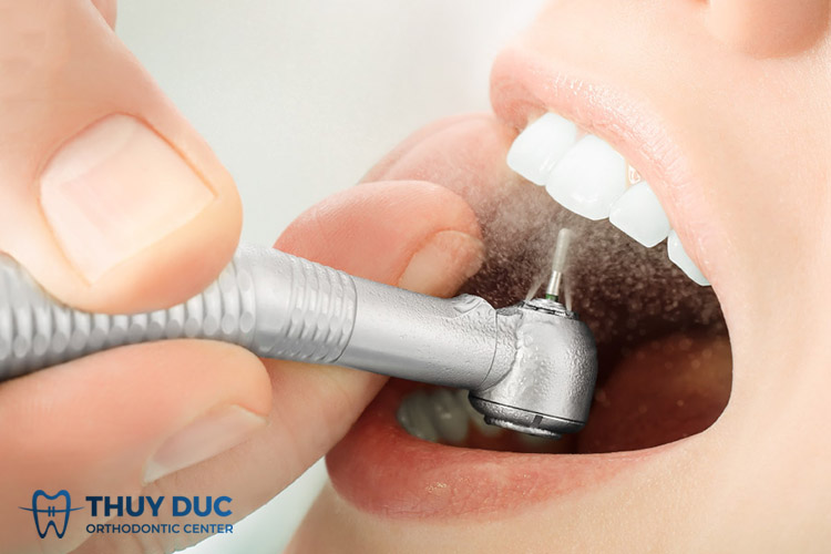 Cách khắc phục răng sâu bị vỡ tốt nhất tại nha khoa Thúy Đức 1