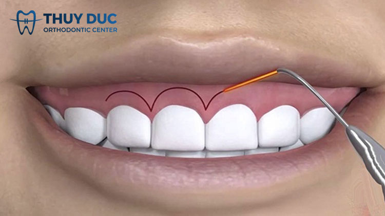 1. Tìm hiểu chung về cắt lợi 1