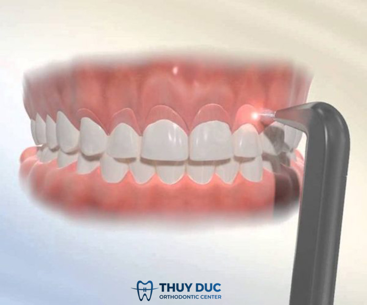 Chữa cười hở lợi cần phẫu thuật 1