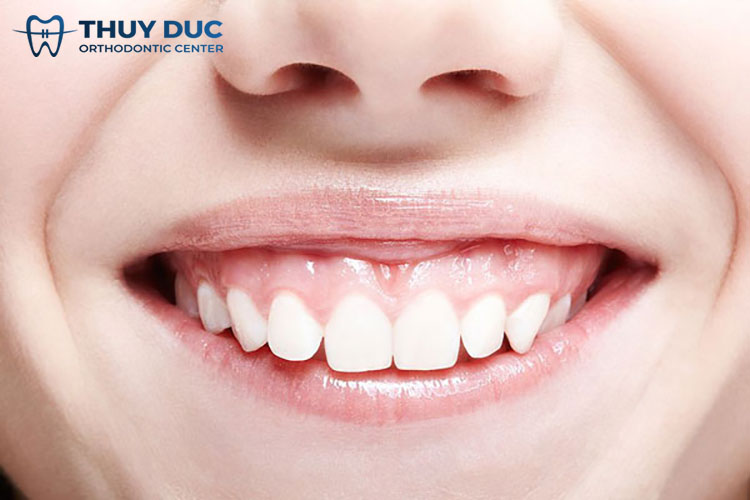 2. Nên cắt lợi trước hay niềng răng trước? 2