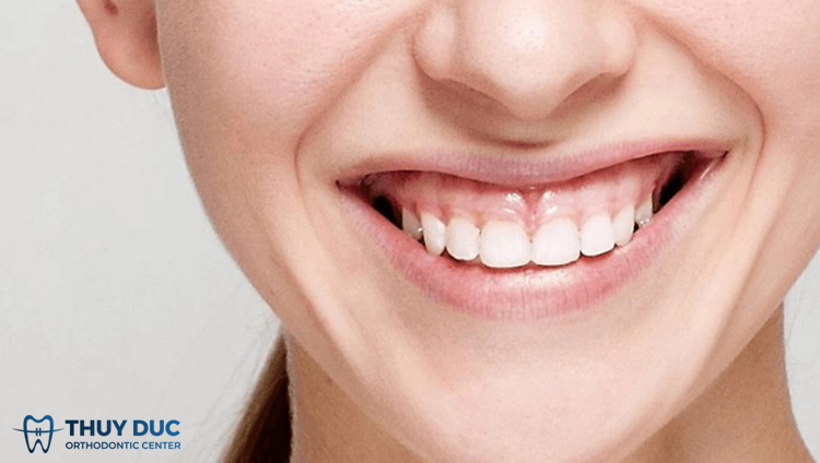 Giải đáp cười hở lợi là gì? 1