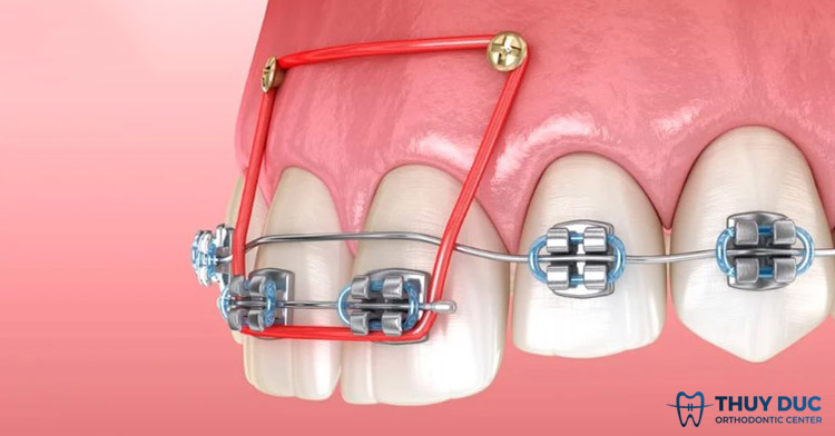 Có những nguy cơ hay vấn đề phát sinh khi bắt vít niềng răng không?