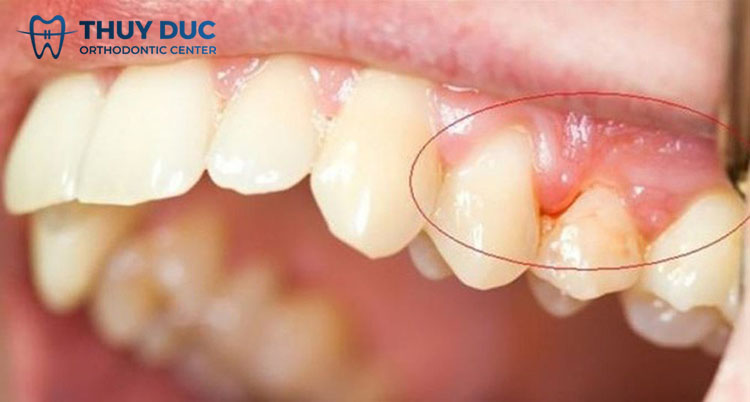 2. Nên cắt lợi trước hay niềng răng trước? 1