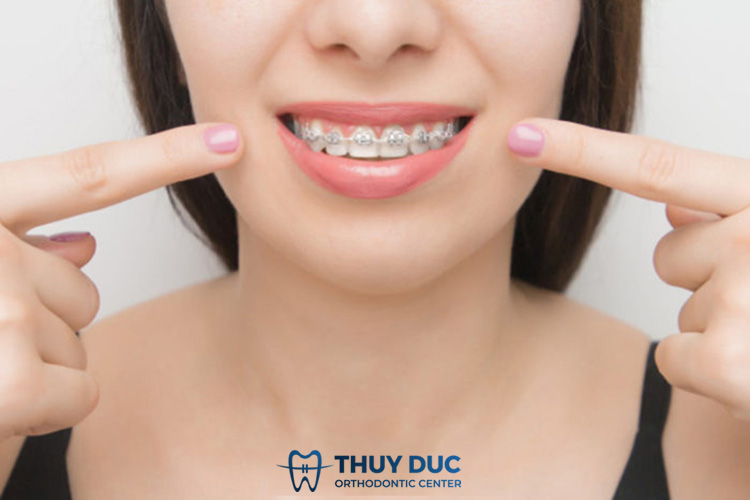 Thời gian chỉnh nha 1