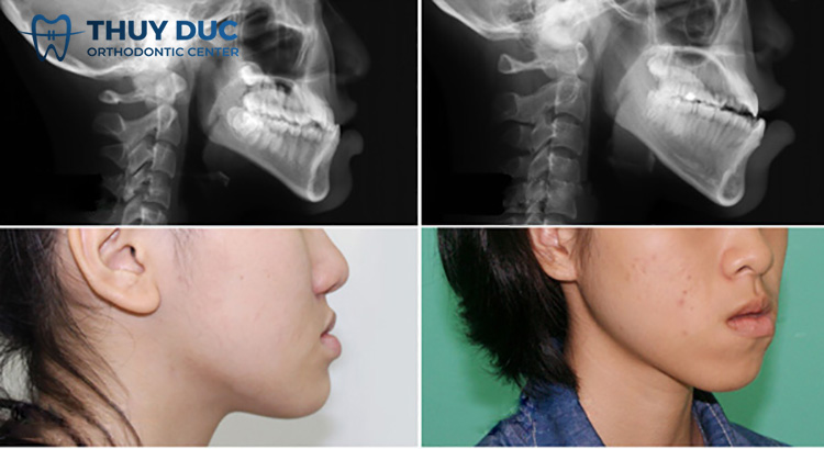 2. Phân biệt răng móm và hàm móm 1 2. Phân biệt răng móm và hàm móm 1
