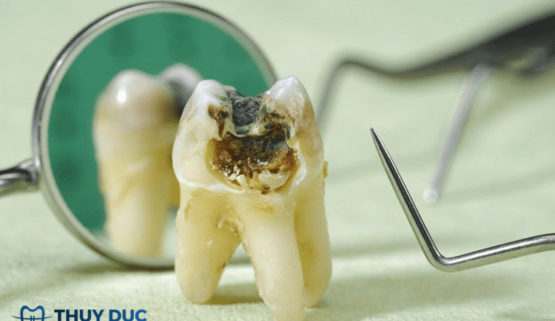 Nằm mơ thấy răng sâu bị vỡ là điềm gì? Giải đáp cụ thể